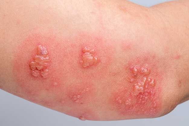 Symptoms and severity of hydrochlorothiazide-induced rash