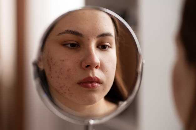 Can hydrochlorothiazide cause acne