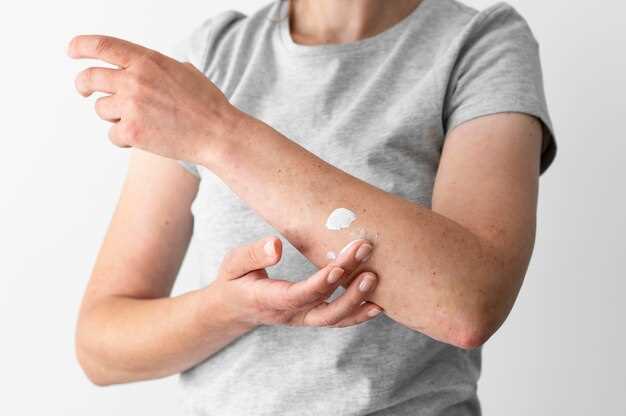 Hydrochlorothiazide and bruising