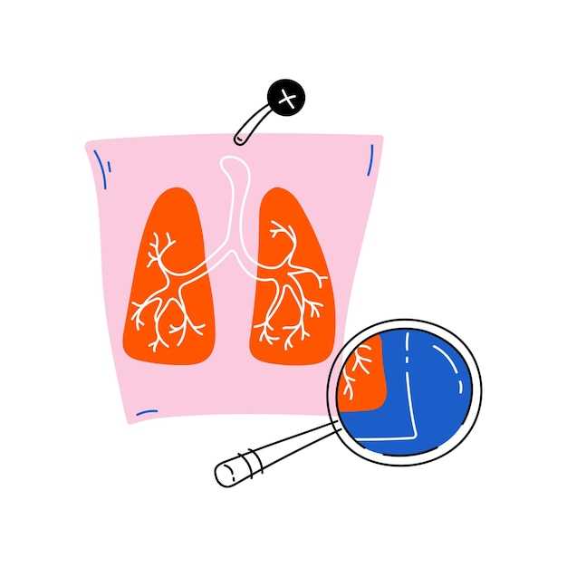 Hydrochlorothiazide pulmonary edema