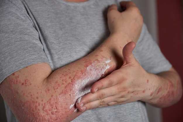 Hydrochlorothiazide rash pictures
