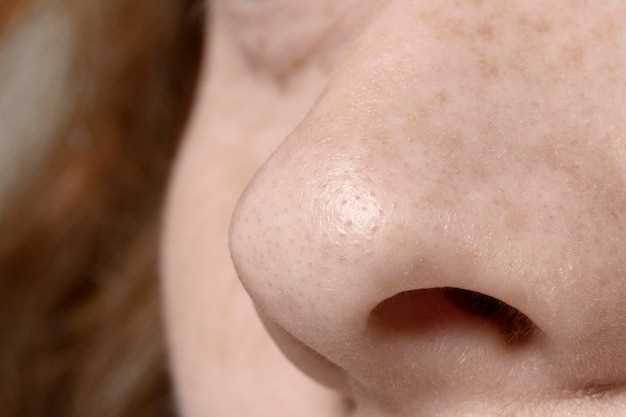 Hydrochlorothiazide skin pigmentation
