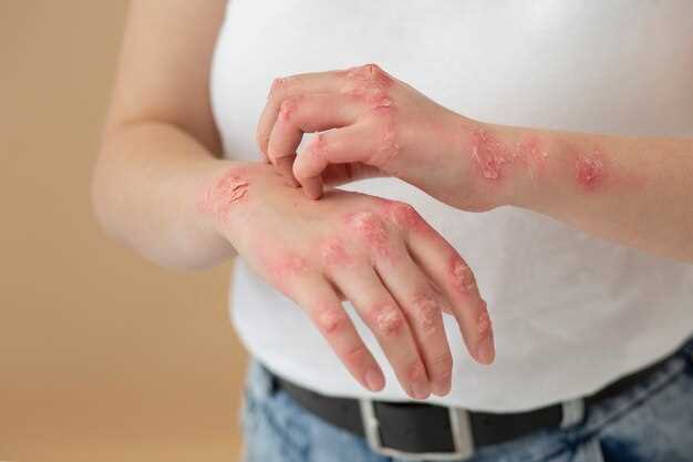 Hydrochlorothiazide skin rash