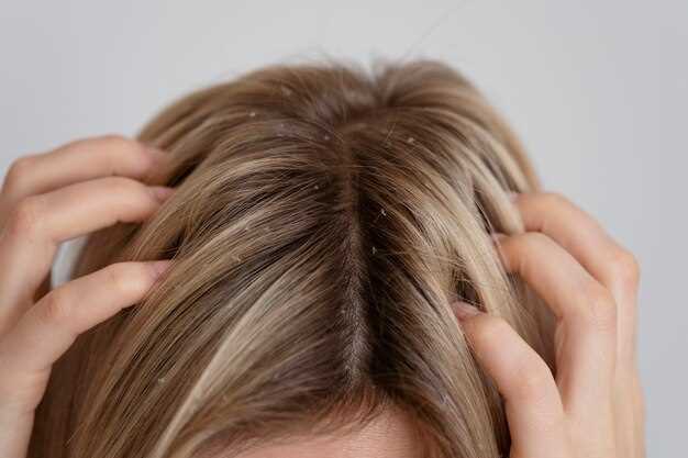 Lisinopril hydrochlorothiazide hair loss